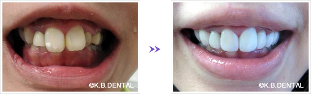 口元：術前術後