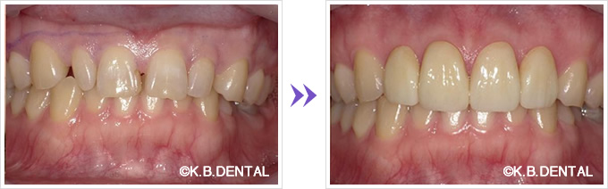 セラミック矯正