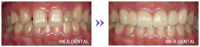 すきっ歯セラミック矯正