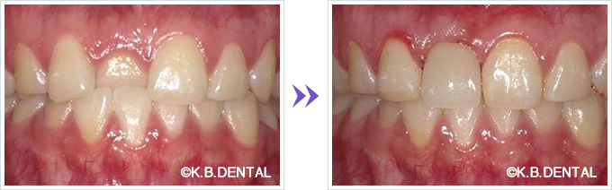 引っ込んだ前歯