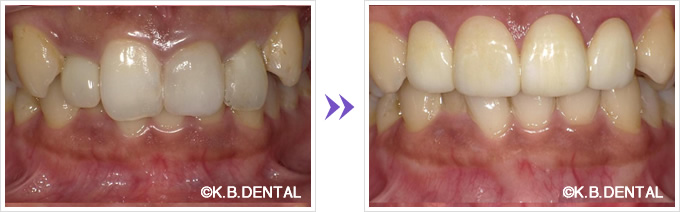 ジルコニアオールセラミッククラウン