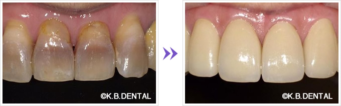 テトラサイクリン変色歯