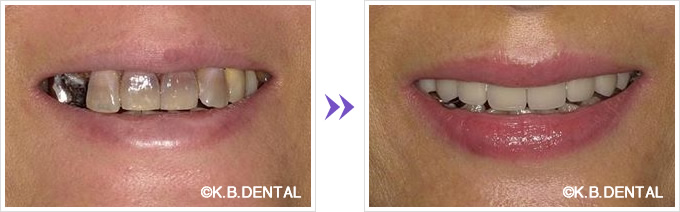 オールセラミッククラウン