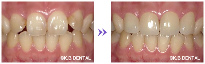 ラミネートべニア