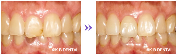 下顎の前歯変色