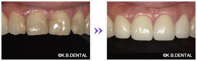 変色前歯4本オールセラミッククラウン
