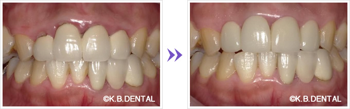 歯ぐき境目の黒ずみ