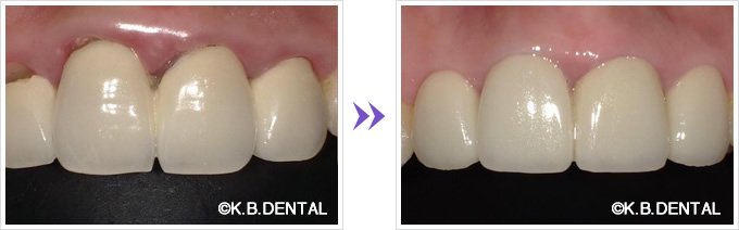 ジルコニアオールセラミックス