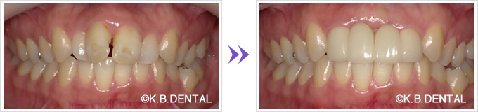 オールセラミッククラウン