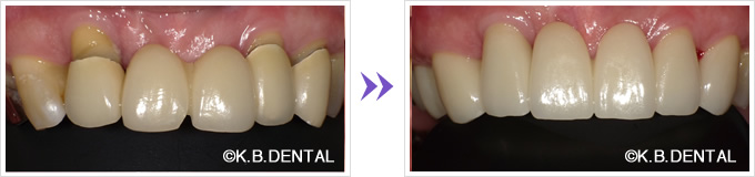 歯周病で下がった歯茎