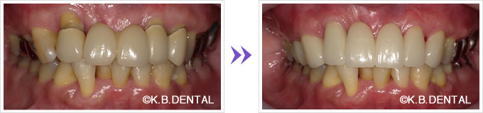 前歯6本オールセラミックス