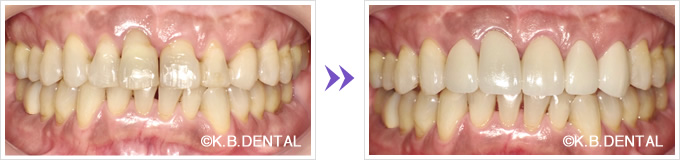 前歯5本のオールセラミック