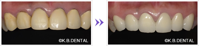 変色した保険適用クラウン