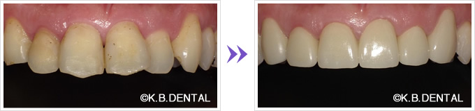 出っ歯前歯6本セラミック