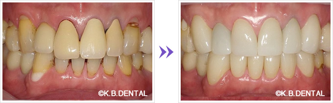 プレミアムジルコニアクラウン