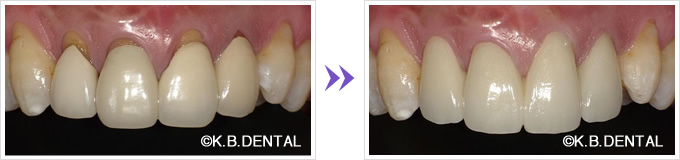 歯ぐきが下がった古いクラウン