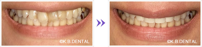 傾き前歯4本オールセラミック