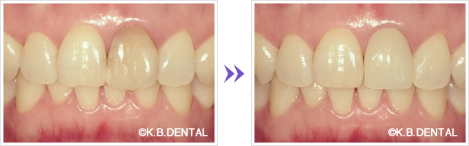 変色前歯1本オールセラミック