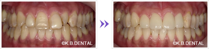 ホワイトニング前歯4本オールセラミック