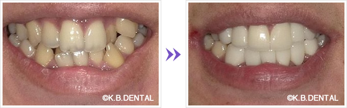 口元：前歯上下6本セラミック矯正