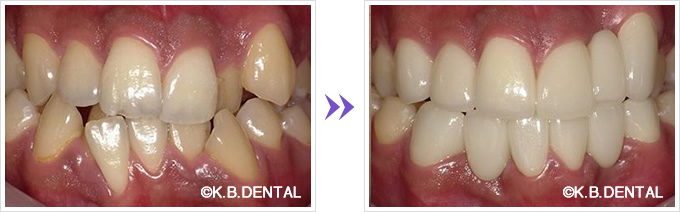 口腔内：前歯上下6本セラミック矯正