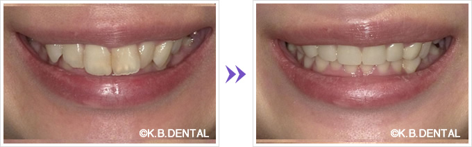 口元：大きい前歯6本セラミック矯正