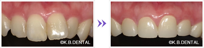 前歯：大きい前歯6本セラミック矯正