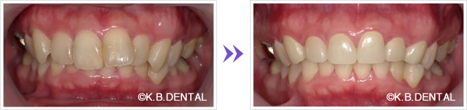 口腔内：大きい前歯6本セラミック矯正