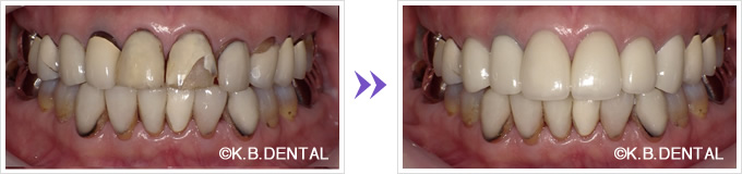 口腔内：オールセラミッククラウンに