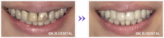 口元：オールセラミッククラウンに