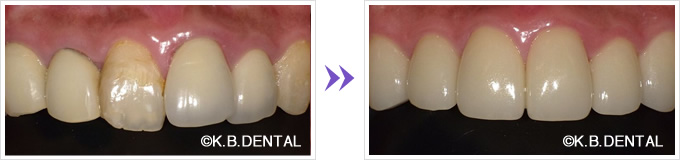 前歯：叢生前歯6本審美セラミック矯正