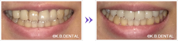 口元：叢生前歯6本審美セラミック矯正正