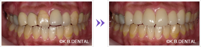 口腔内：叢生前歯6本審美セラミック矯正
