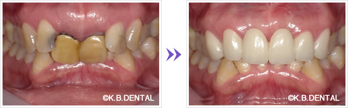 口腔内：前歯6本審美セラミックブリッジ