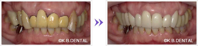 口腔内：セラミック審美ブリッジ