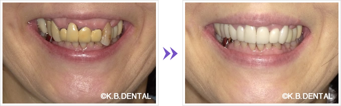 口元：セラミック審美ブリッジ