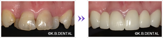 前歯：叢生前歯6本セラミック矯正