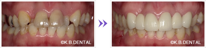 口腔内：叢生前歯6本セラミック矯正
