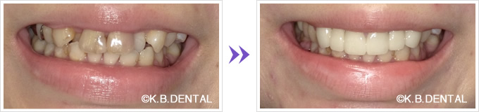 口元：叢生前歯6本セラミック矯正