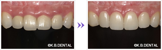 前歯：歯肉切除＋セラミック矯正