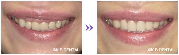 口元：歯肉切除＋セラミック矯正