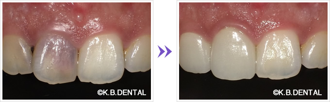 クローズアップ：失活歯をセラミック