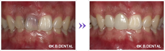 口腔内：失活歯をセラミック