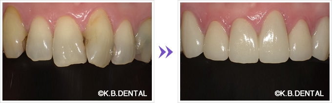 クローズアップ：捻じれた前歯6本をセラミック