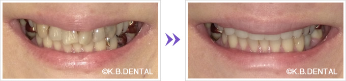 口元：捻じれた前歯6本をセラミック