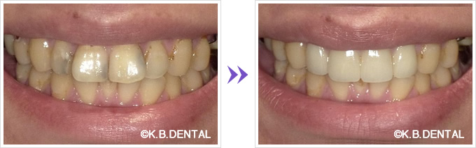 前歯4本をセラミック