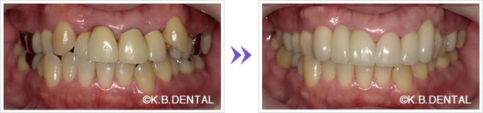 奥歯・前歯のセラミック