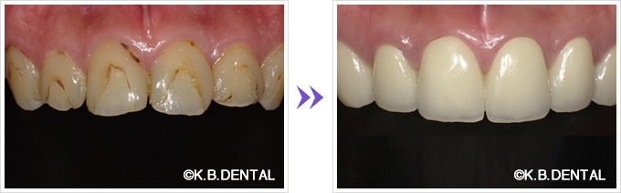 前歯：インプラントを併用したセラミック