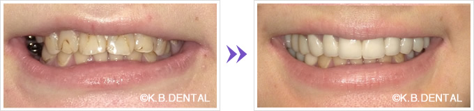 口元：インプラントを併用したセラミック