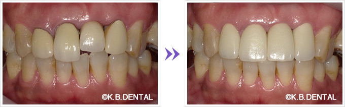 口腔内：前歯4本をセラミック